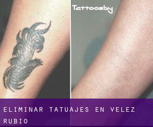 Eliminar tatuajes en Velez Rubio