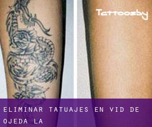 Eliminar tatuajes en Vid de Ojeda (La)