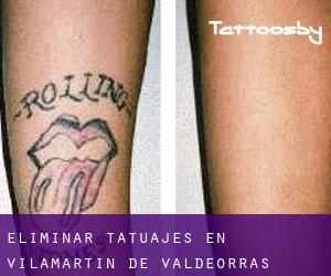 Eliminar tatuajes en Vilamartín de Valdeorras