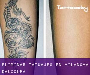 Eliminar tatuajes en Vilanova d'Alcolea
