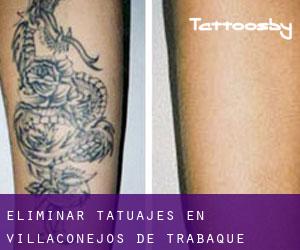 Eliminar tatuajes en Villaconejos de Trabaque
