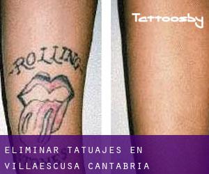 Eliminar tatuajes en Villaescusa (Cantabria)