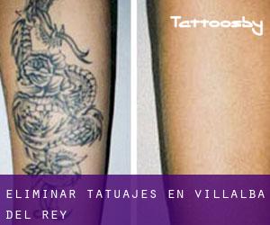 Eliminar tatuajes en Villalba del Rey
