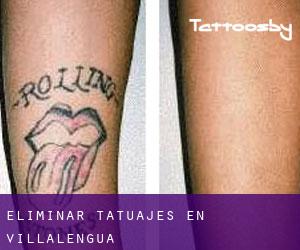 Eliminar tatuajes en Villalengua