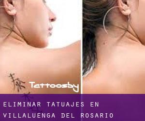 Eliminar tatuajes en Villaluenga del Rosario