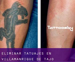 Eliminar tatuajes en Villamanrique de Tajo