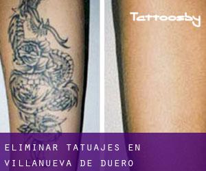 Eliminar tatuajes en Villanueva de Duero