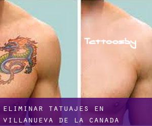 Eliminar tatuajes en Villanueva de la Cañada