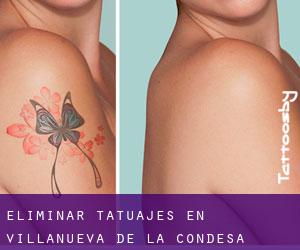 Eliminar tatuajes en Villanueva de la Condesa
