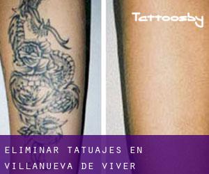 Eliminar tatuajes en Villanueva de Viver