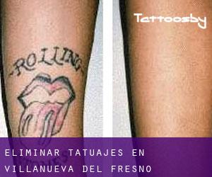Eliminar tatuajes en Villanueva del Fresno