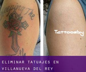 Eliminar tatuajes en Villanueva del Rey