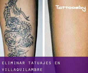 Eliminar tatuajes en Villaquilambre