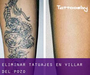 Eliminar tatuajes en Villar del Pozo
