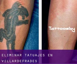 Eliminar tatuajes en Villardefrades