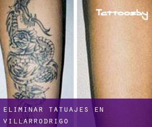 Eliminar tatuajes en Villarrodrigo