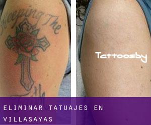 Eliminar tatuajes en Villasayas