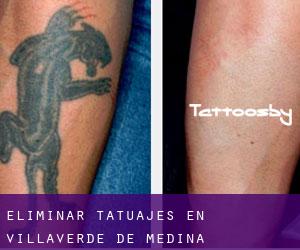Eliminar tatuajes en Villaverde de Medina