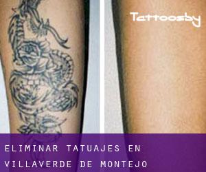 Eliminar tatuajes en Villaverde de Montejo