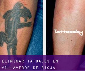 Eliminar tatuajes en Villaverde de Rioja