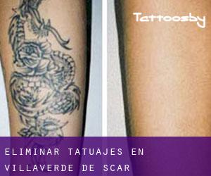 Eliminar tatuajes en Villaverde de Íscar