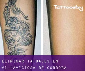 Eliminar tatuajes en Villaviciosa de Córdoba