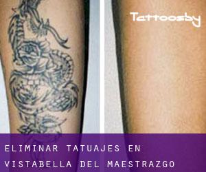 Eliminar tatuajes en Vistabella del Maestrazgo