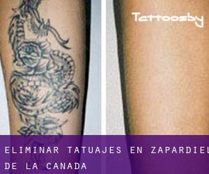 Eliminar tatuajes en Zapardiel de la Cañada