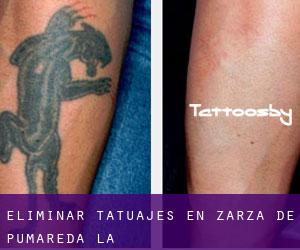 Eliminar tatuajes en Zarza de Pumareda (La)
