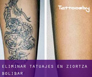 Eliminar tatuajes en Ziortza-Bolibar